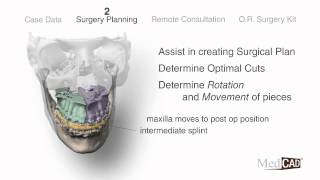 OsteoMed and Med CAD Present Orthognathic Surgery Planning [upl. by Aisatan]