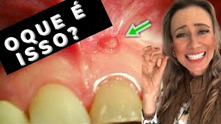 ESPINHA NA BOCA🤢😰 fistula dravanessagualda canal endodontia [upl. by Tolecnal]