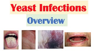 Candidal Yeast Infections Overview  Oral Thrush Vaginal Intertrigo Esophageal Candidiasis [upl. by Asabi]