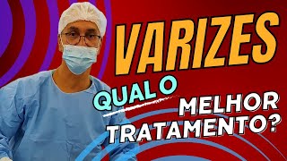 O melhor tratamento para varizes [upl. by Ttevi]