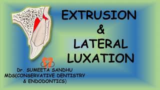 Extrusion and lateral luxation of teeth  Management Luxation injuries [upl. by Garrity572]