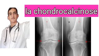 la chondrocalcinose [upl. by Candyce]