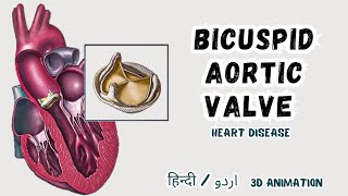 Bicuspid Aortic Valve Kon Si Disease Hai  3D animation in हिंदी  اردو  cardiology [upl. by Ebony]