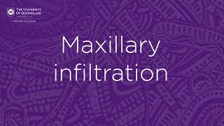 Dental local anaesthetics Maxillary infiltration [upl. by Nnaul]