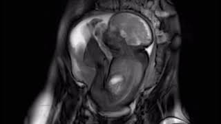 MRI Fetus 32 weeks [upl. by Ajiam992]