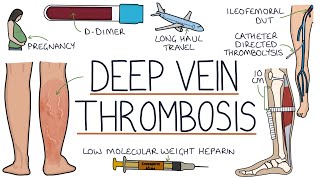 Understanding Deep Vein Thrombosis DVT [upl. by Rolfe]