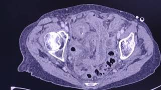 Small bowel obstruction due to 2 different causes Unusual case CT findings [upl. by Nitnelav]