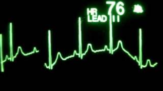 Sinus Rhythm with Respirations [upl. by Katlaps]