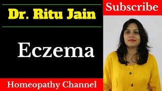 एक्जिमा का इलाज  Homeopathic Medicine amp Treatment For Eczema in Hindi How to cure eczema fast [upl. by Kelwunn410]