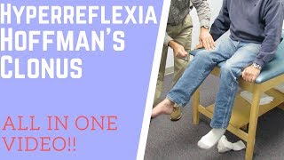 Hyperreflexia clonus and positive Hoffmans sign [upl. by Serge]