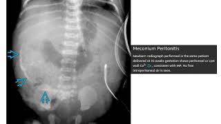 Meconium Peritonitis Imaging [upl. by Htebezile322]