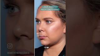 NONSURGICAL NECK CONTOURING laserliposuction snatched neck [upl. by Lustig742]