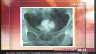 Litiasis Renal síntomas consecuencias y prevención [upl. by Mareld]