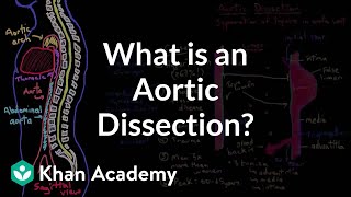 What is an aortic dissection  Circulatory System and Disease  NCLEXRN  Khan Academy [upl. by Rose]