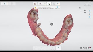 Implant level scans with 3Shape Trios [upl. by Aiselad677]