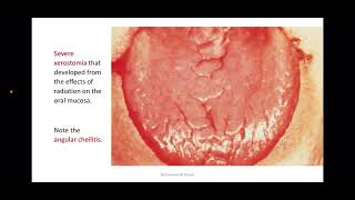 Patients on Radiotherapy and Chemotherapy part2 [upl. by Yole]