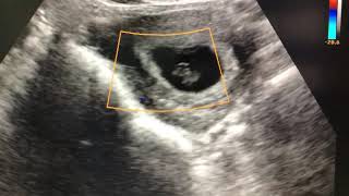 Omphalocele in 8 weeks fetus [upl. by Osber]