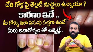 చేతి గోళ్లపై తెల్లటి మచ్చలకు కారణం ఇదే  Behind The Reason For White Spots On Your Nails [upl. by Dich]