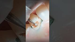 How To Fix Cavities In Front Teeth [upl. by Gnok]