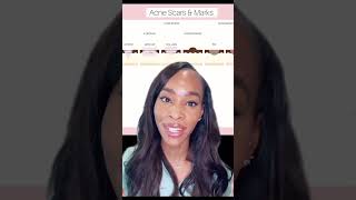 HOW TO REDUCE ACNE SCARS [upl. by Aiciram981]