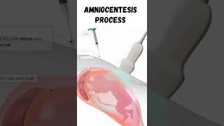 Amniocentesis anatomy biology [upl. by Aidnyl]