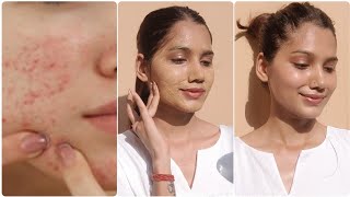 कितने भी मुस्किल pimple amp acne को बोलो अलविदा  clear tiny bump on face [upl. by Airdnahs]