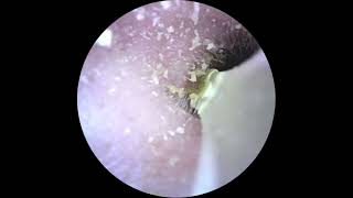 Longest Earwax Removal Crazy earwaxremoval asmr satisfying wax crazy mostsatisfyingvideo [upl. by Zzahc]