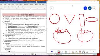 د السكري contracted pelvis cpd [upl. by Krystle487]