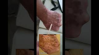 week 10 hand vitiligo treatment [upl. by Rekcut]