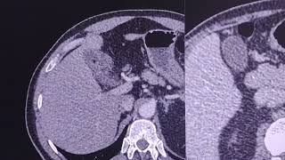 Gallbladder minimal CT findings [upl. by Tempest102]