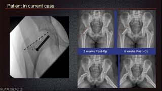 Sports Medicine Case 41 10yearold female Young Athlete Slipped Up by Hip Pain [upl. by Mariel967]