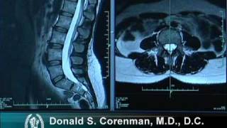 How to Read a MRI of the Normal Lumbar Spine  LowerBack  Vail Spine Specialist [upl. by Kathryne]