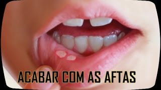 Como Acabar com as Aftas [upl. by Uohk]