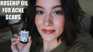 TRYING ROSEHIP OIL FOR A MONTH FOR ACNE SCARS [upl. by Detta523]