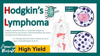 Hodgkin Lymphoma  Hodgkin’s lymphoma  Hodgkin’s Disease  ReedSternberg Cell  Pathology [upl. by Obla]