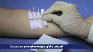 DermaClip Basic Overview a NonInvasive Wound Closure Device [upl. by Avie788]