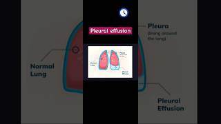 Pleural effusion Xray chest PAtypes of fluidetiology [upl. by Ivek]