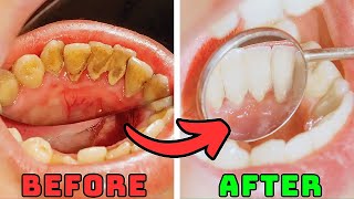 Top 5 Natural Remedies to Remove Plaque and Tartar From Teeth [upl. by Aldin]