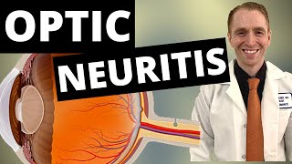 Optic Neuritis Symptoms Diagnosis and Treatment [upl. by Balcer]