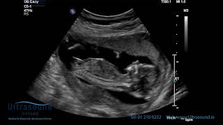 Scan of the Week 15 Weeks Pregnant The Advanced Early Ultrasound [upl. by Ybrad]