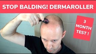 STOP BALDING  Dermaroller 3 Month Test and Tutorial [upl. by Mitinger]