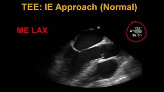 Transesophageal Echocardiography Infective Endocarditis [upl. by Aimej]