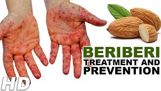 Beriberi Treatment And PreventionWays To Prevent Beriberi Disease SymptomsBeriberi Pictures [upl. by Llenoil]