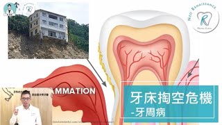 【牙周病，牙床的掏空危機】牙周病到底是什麼？該如何治療？｜Dr 林葳牙科診療室 [upl. by Eveivaneg]