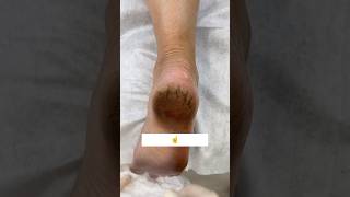 👠Get Rid Of Cracked Heels  Repair Cracked Heels In 1Day cracked heels feetcare youtubeshorts [upl. by Acnalb]