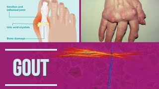 GOUT  Podagra  stages  pathophysiology clinical symptoms diagnosis  management [upl. by Poll]