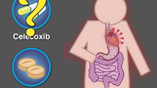 Cardiovascular Safety of Celecoxib  NEJM [upl. by Thrift87]