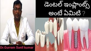 Dental Implants explained by Dr Gurram sunil kumar in telugu  Dental Health Tips [upl. by Kaspar]