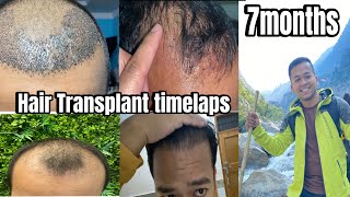 Hair transplant time lapse  Hair transplant before and after results [upl. by Suoinuj540]