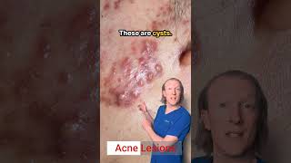 Acne Lesions White Heads Black heads Pustules Papules Cysts amp Nodules [upl. by Mistrot]